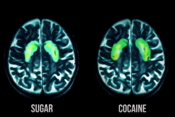 How Sugar Affects Your Brain